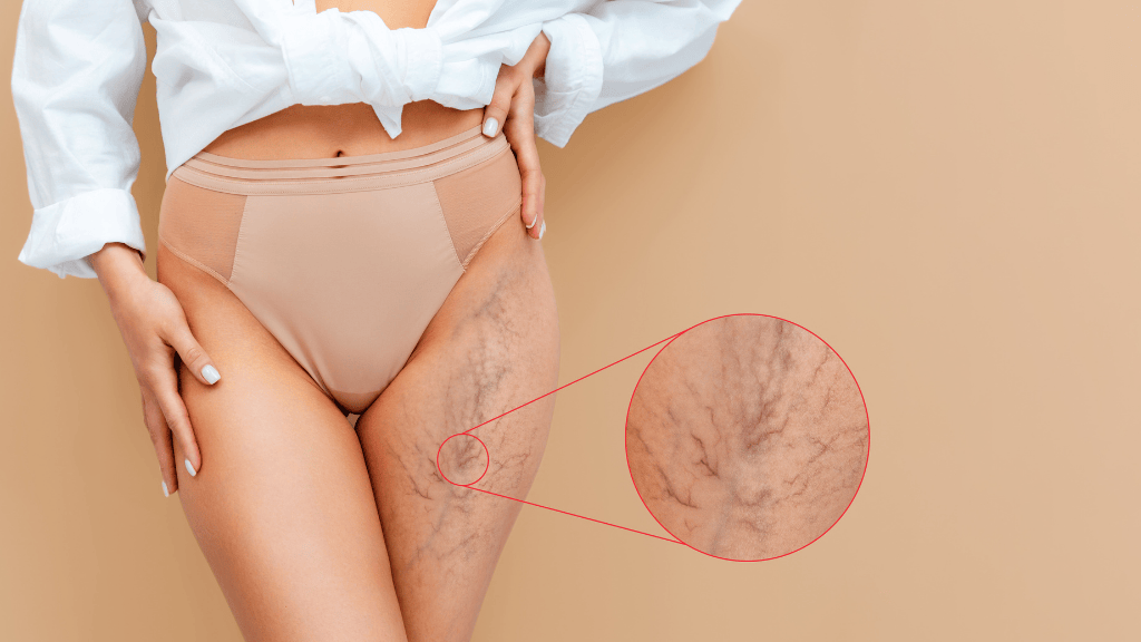 arañas vasculares toledo