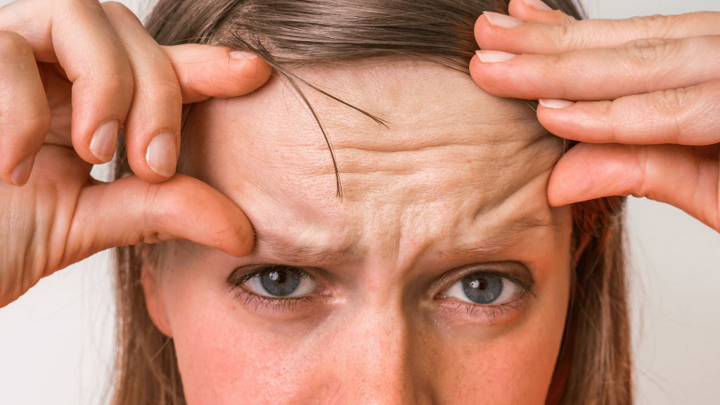 Ejemplo de arrugas de expresión en la frente tratables con neuromoduladores