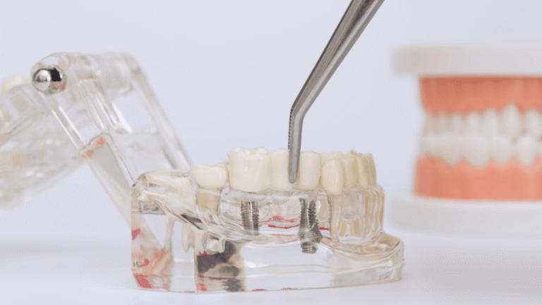 Implante dental colocado en dentadura artificial para tratamiento de implantes dentales en Toledo