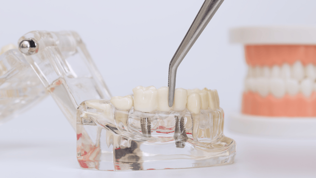 Implante dental colocado en dentadura artificial para tratamiento de implantes dentales en Toledo