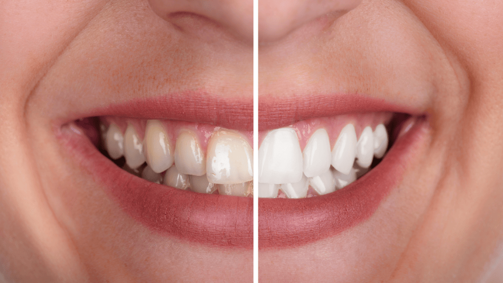 Antes y después de un blanqueamiento dental en Toledo con resultado natural