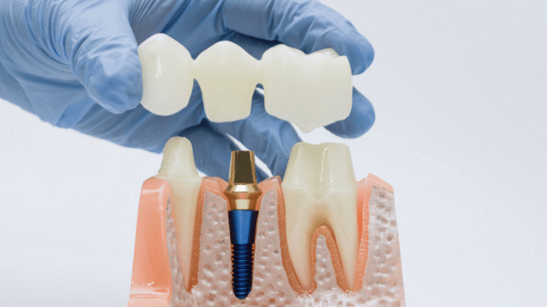 Maqueta de dientes mostrando un implante dental con estructura de corona y raíz
