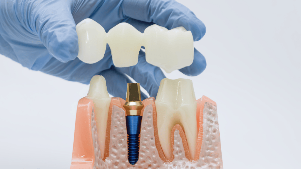 Maqueta de dientes mostrando un implante dental con estructura de corona y raíz