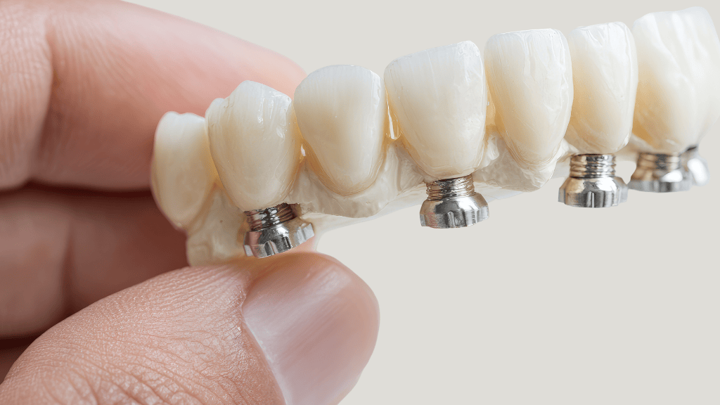 Detalle de implantes dentales en Toledo mostrando la estructura de la corona y el implante