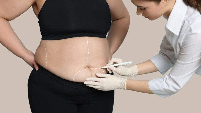 Doctora realizando marcaje preoperatorio en abdomen para liposucción en clínica de Toledo. Imagen ilustrativa