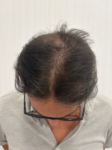 Antes