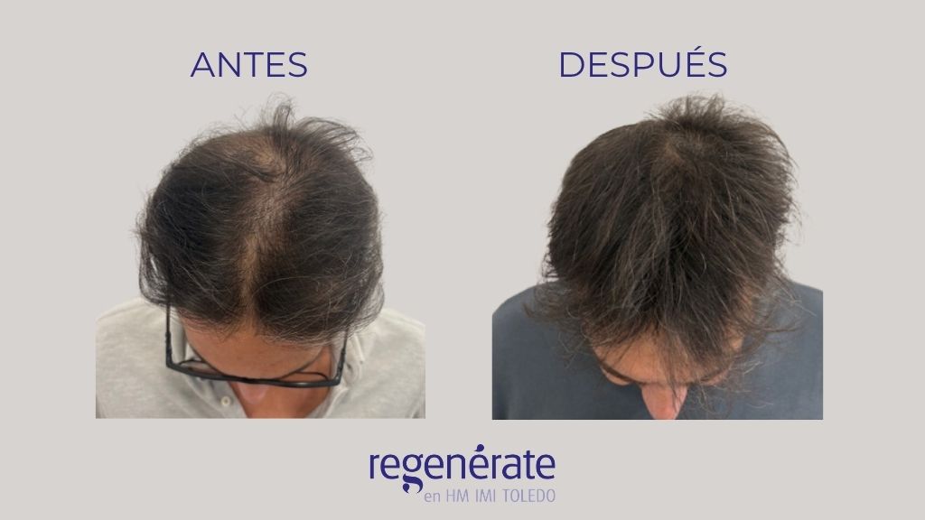 Resultado real de tratamiento capilar en Toledo antes y después en paciente de Regenérate