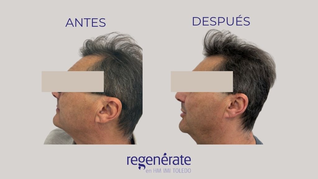 Antes y después de tratamiento capilar en Toledo con mejora de la densidad capilar visto desde un ángulo lateral