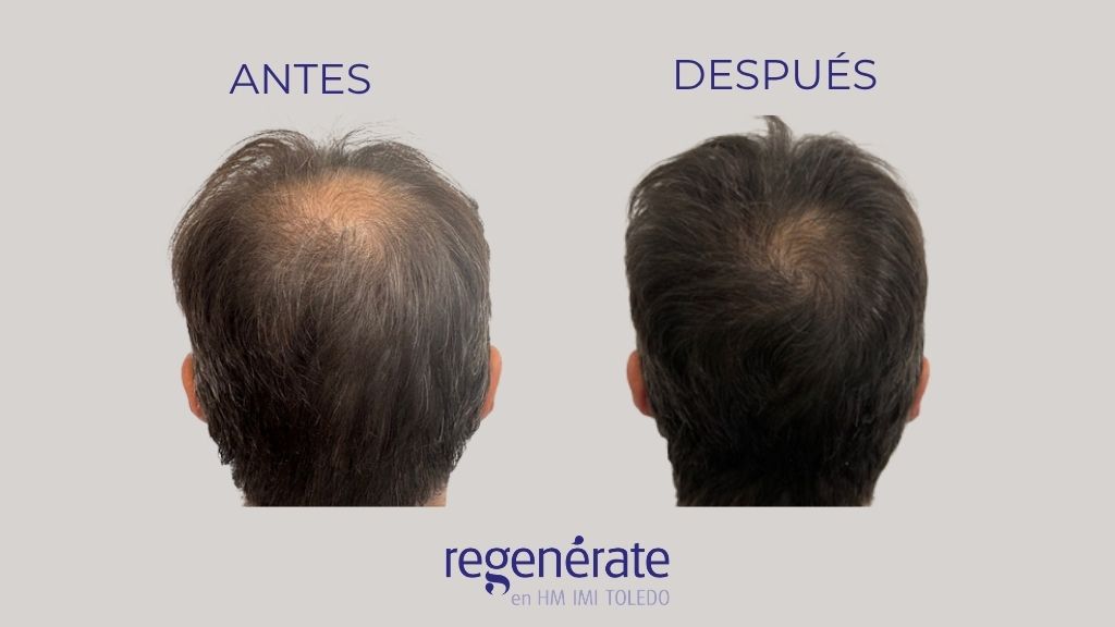 Antes y después de tratamiento capilar en Toledo con mejora de la densidad en la coronilla