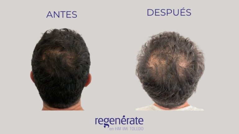 Comparativa antes y después de la densidad capilar en la coronilla de un paciente