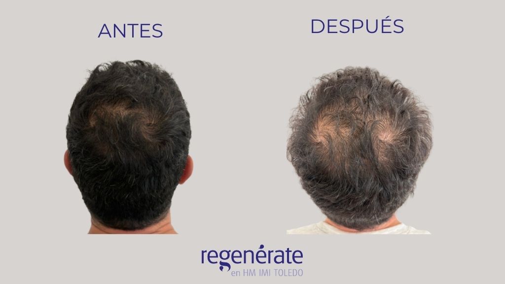 Comparativa antes y después de la densidad capilar en la coronilla de un paciente