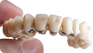 Implantes de mordida completa