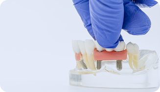 Implantes múltiples