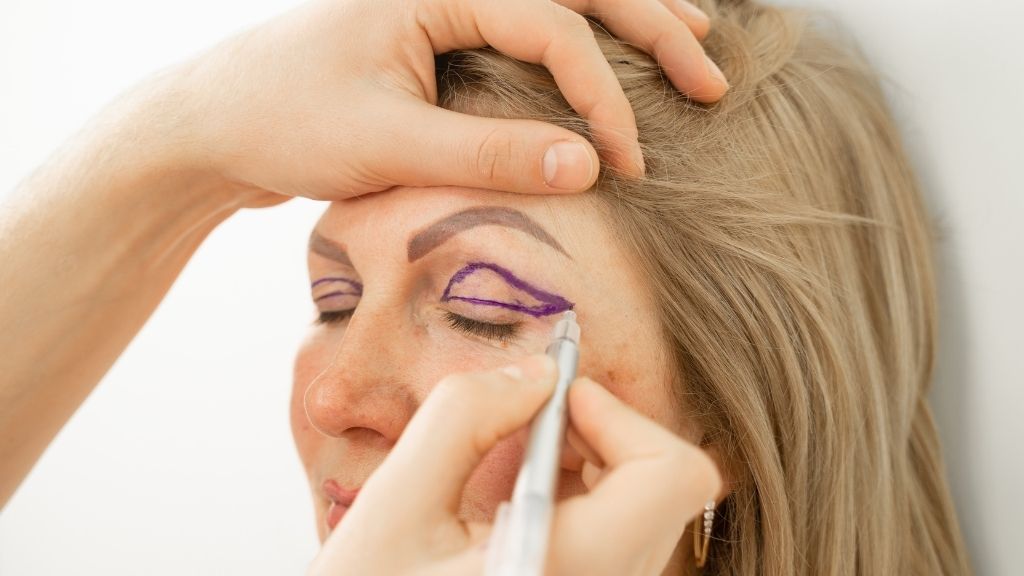 Marcaje de los párpados antes de una blefaroplastia