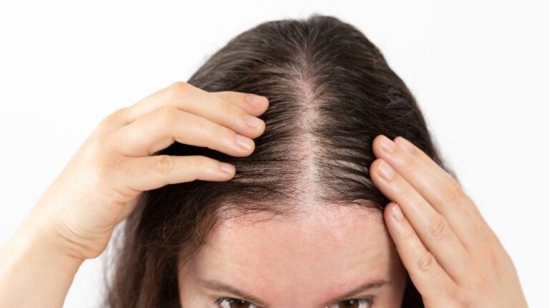 Caída difusa del cabello y efluvio telógeno